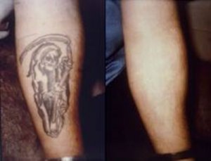 Before and After of a Permanent Tattoo Removed