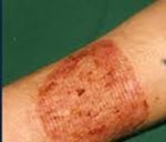 Image of the scarification caused by getting a tattoo removed via dermabrasion. Looks Painful.