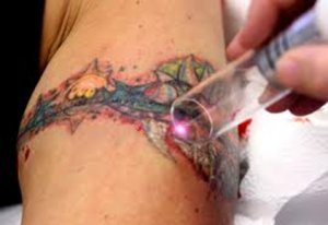 A tattoo being removed with a laser