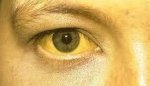 This is an image of what someones eye looks like with jaundice