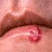 This is an image of a cold sore on someones lip